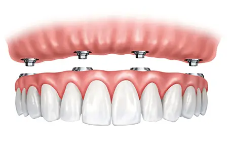 Diagram showing how All-On-X dental implants anchor a full arch of teeth to the jawbone