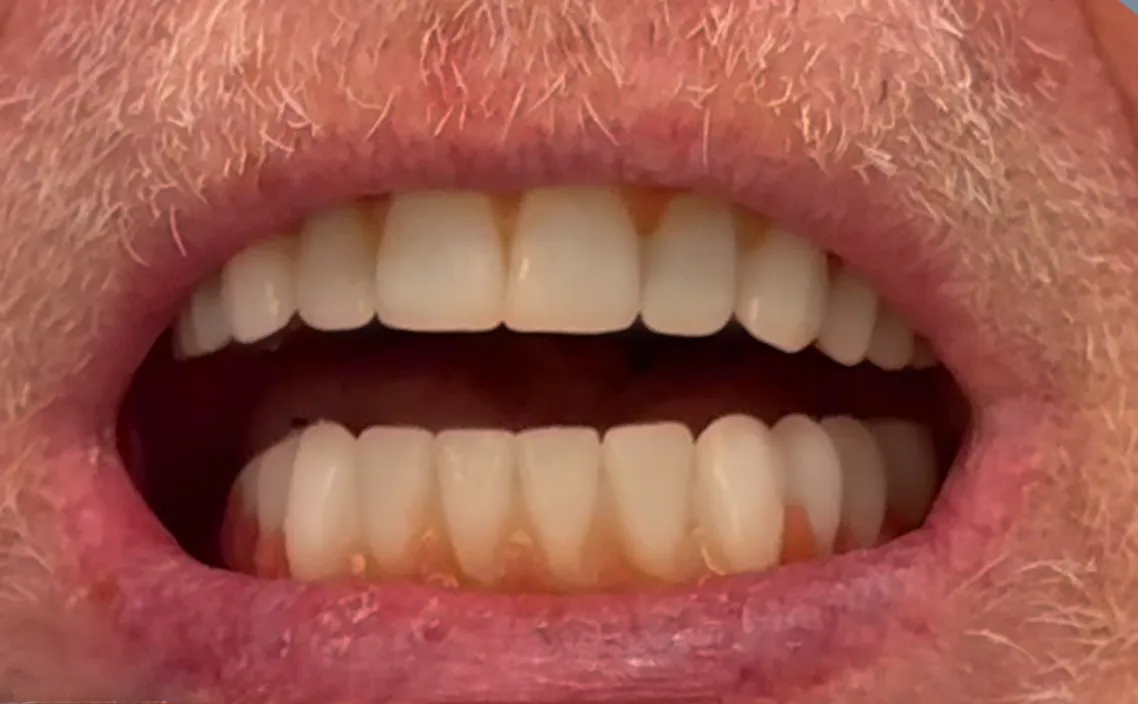 Close-up photo showing full-arch All-On-X implant denture result on male patient
