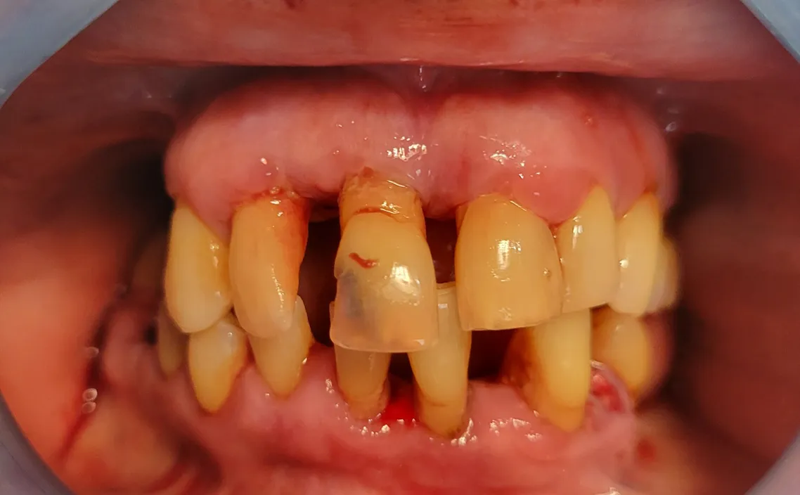 Close-up of male patient’s mouth showing advanced tooth loss before All-On-X implant treatment